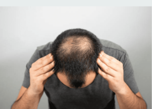 7 Natural and Effective Ways to Stop Baldness in Men