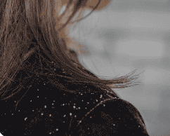 Close-up of a woman with dandruff flakes on her shoulder.